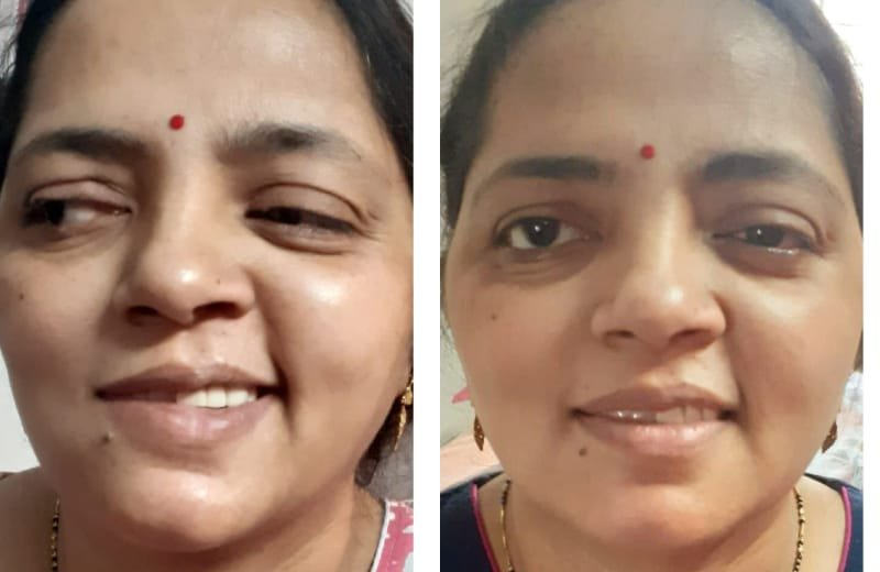 Bells palsy neuroone physio