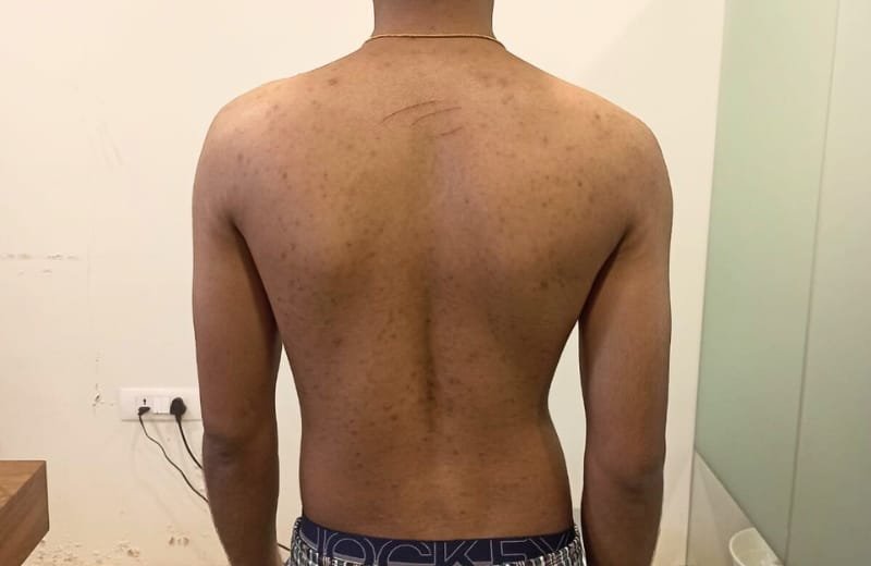 Scoliosis neuroone physio