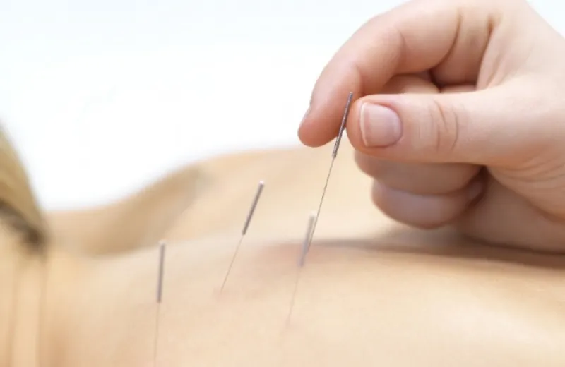 Dry needle Neuroone physio